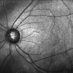 retina