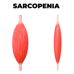 sarcopenia