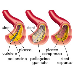 angioplastica.jpg